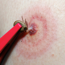 Tick being removed with tweezers from area on skin of bull's eye rash.